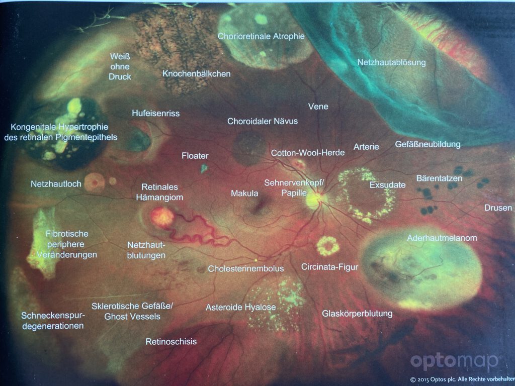 optomap Netzhautuntersuchung OHNE PUPILLENERWEITERUNG